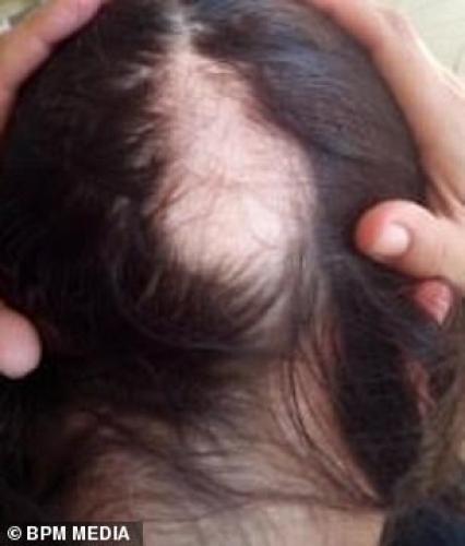 ¿La caída de cabello es un síntoma del Covid-19?