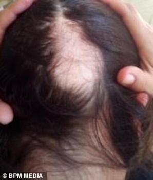 ¿La caída de cabello es un síntoma del Covid-19?