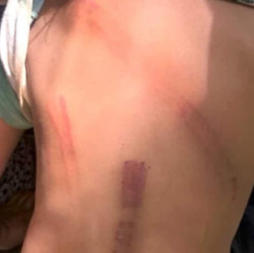 Brutalidad: Golpeó con un palo de escoba a su hija de 10 años