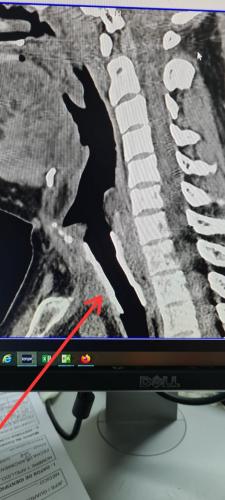 Paciente Post Covid: Se tuvo que implantar sonda hueca para respirar mejor