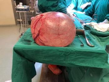 Extraen tumor gigante de 15 kilos a una mujer