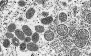 ¿Puede convertirse en pandemia la viruela de mono?